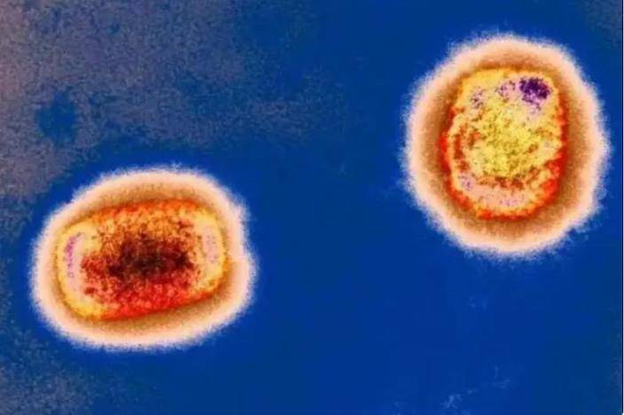 彩色透射電子顯微捕獲的猴痘病毒顆粒。