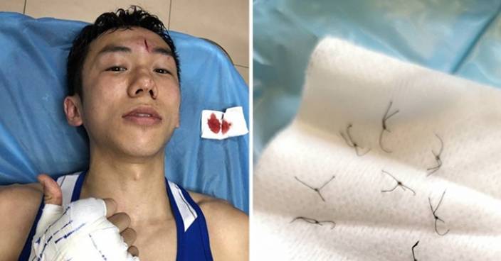 上海比賽受傷入院縫8針 曹星如：從不怕輸會繼續裝備自己