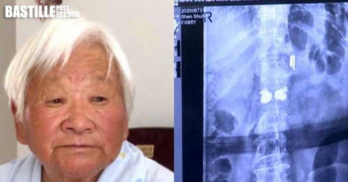 江蘇婦年幼遇日侵華遭槍擊 子彈殘留身體長達80年