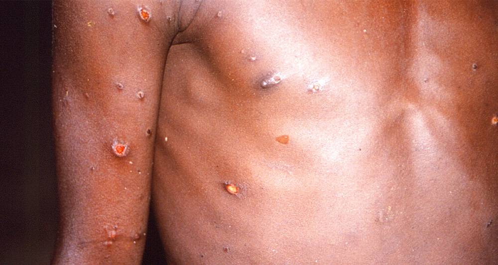 猴痘蔓延全球31個國家逾1300宗病例 專家指疫情可控