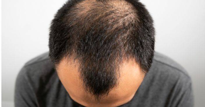 Can Hair Loss At Age 20 Become An M-Shaped Forehead? Experts Teach 4 Strokes To Protect Hair And Prevent Baldness