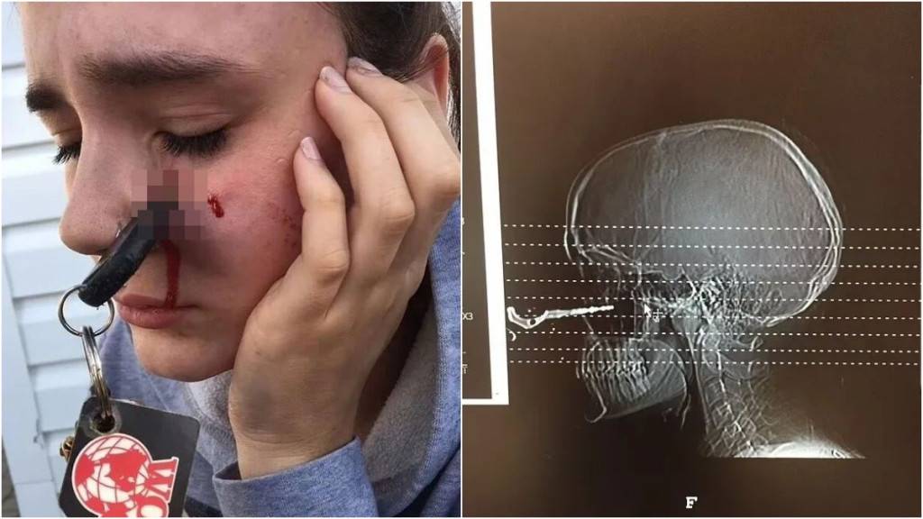 朋友掟車匙 加拿大女子意外被擊中直插臉頰