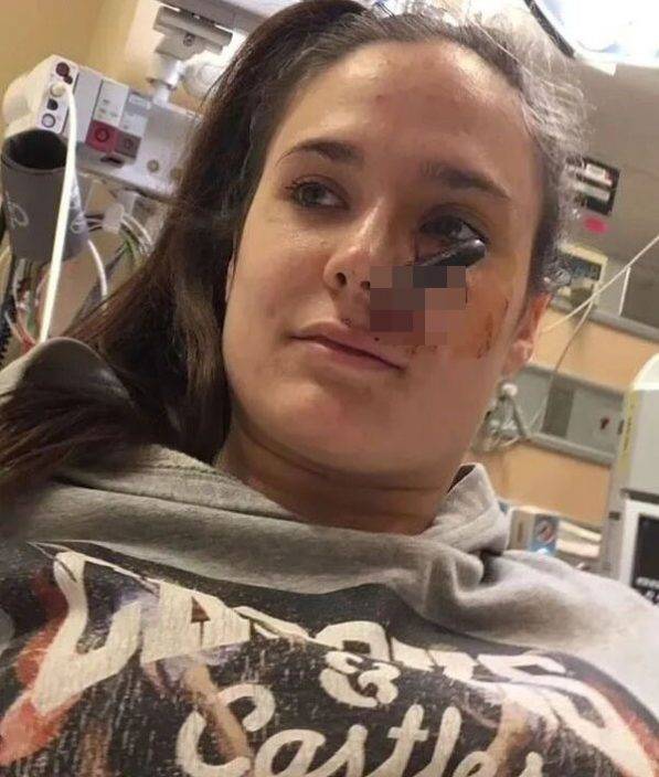 朋友掟車匙 加拿大女子意外被擊中直插臉頰