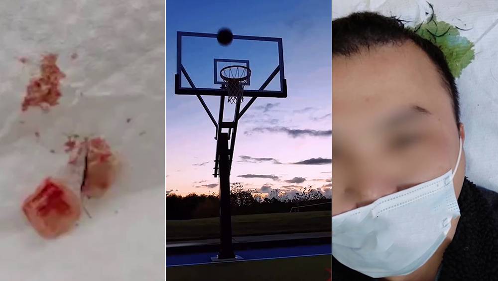 廣東男打完籃球6天後頭頂有腐臭味 就診頭皮竟發現2顆牙